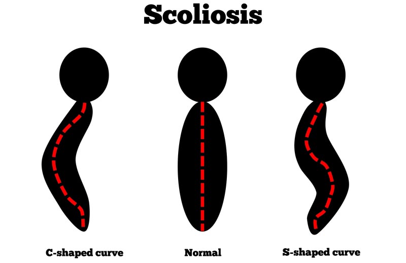 Houston, TX scoliosis treatment